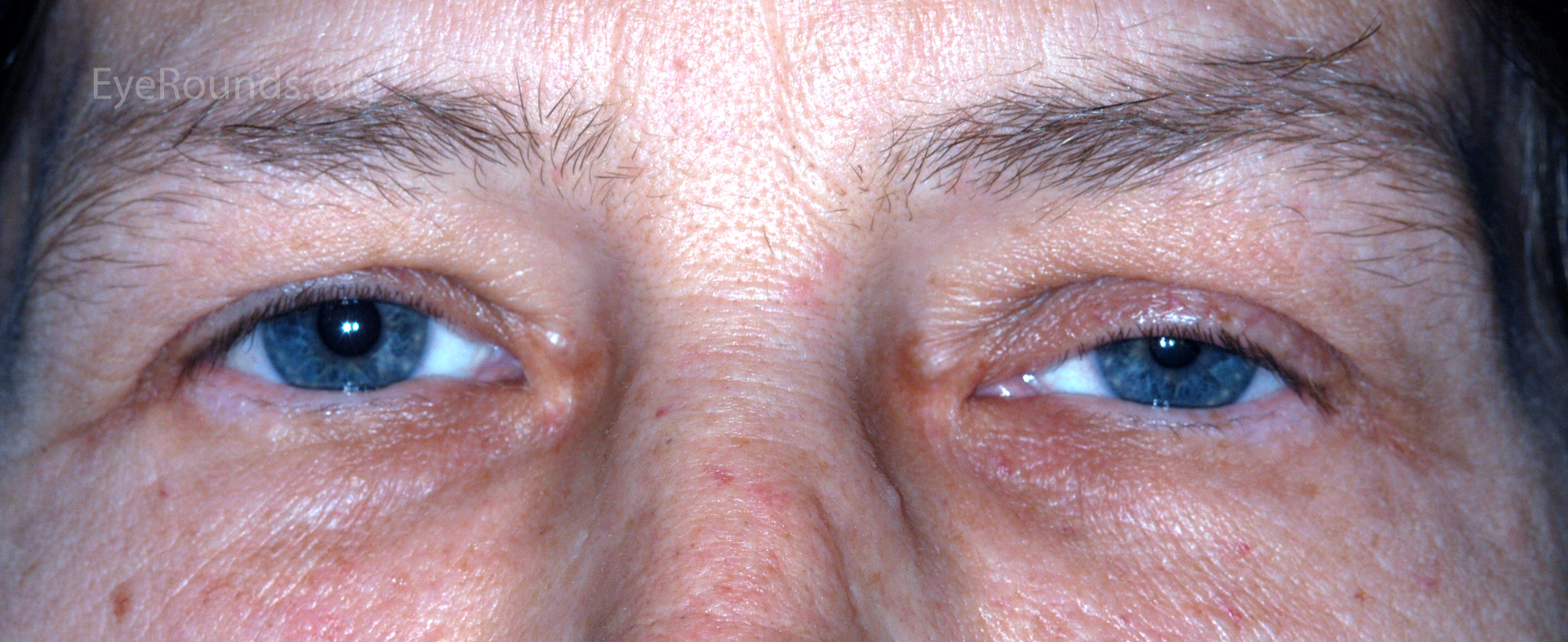 mild ptosis and miosis of the left eye 