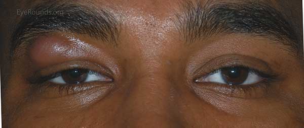 A Primer On Ptosis