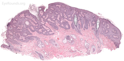 Seborrheic keratosis pathology