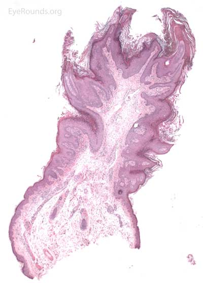 Verruca vulgaris pathology