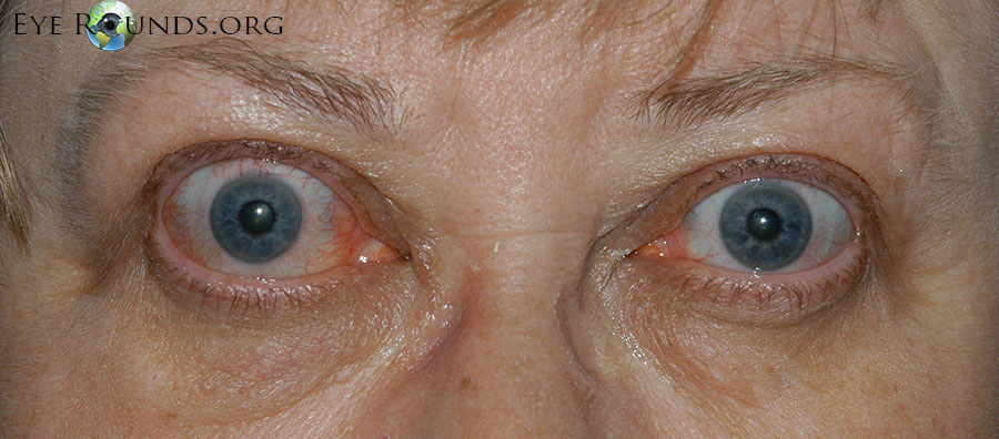  Thyroid Eye Disease. Paitent exhibits classic signs of the diesase.