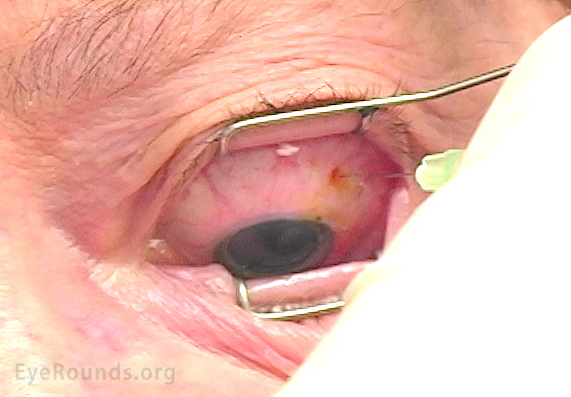 Intravitreal injection 