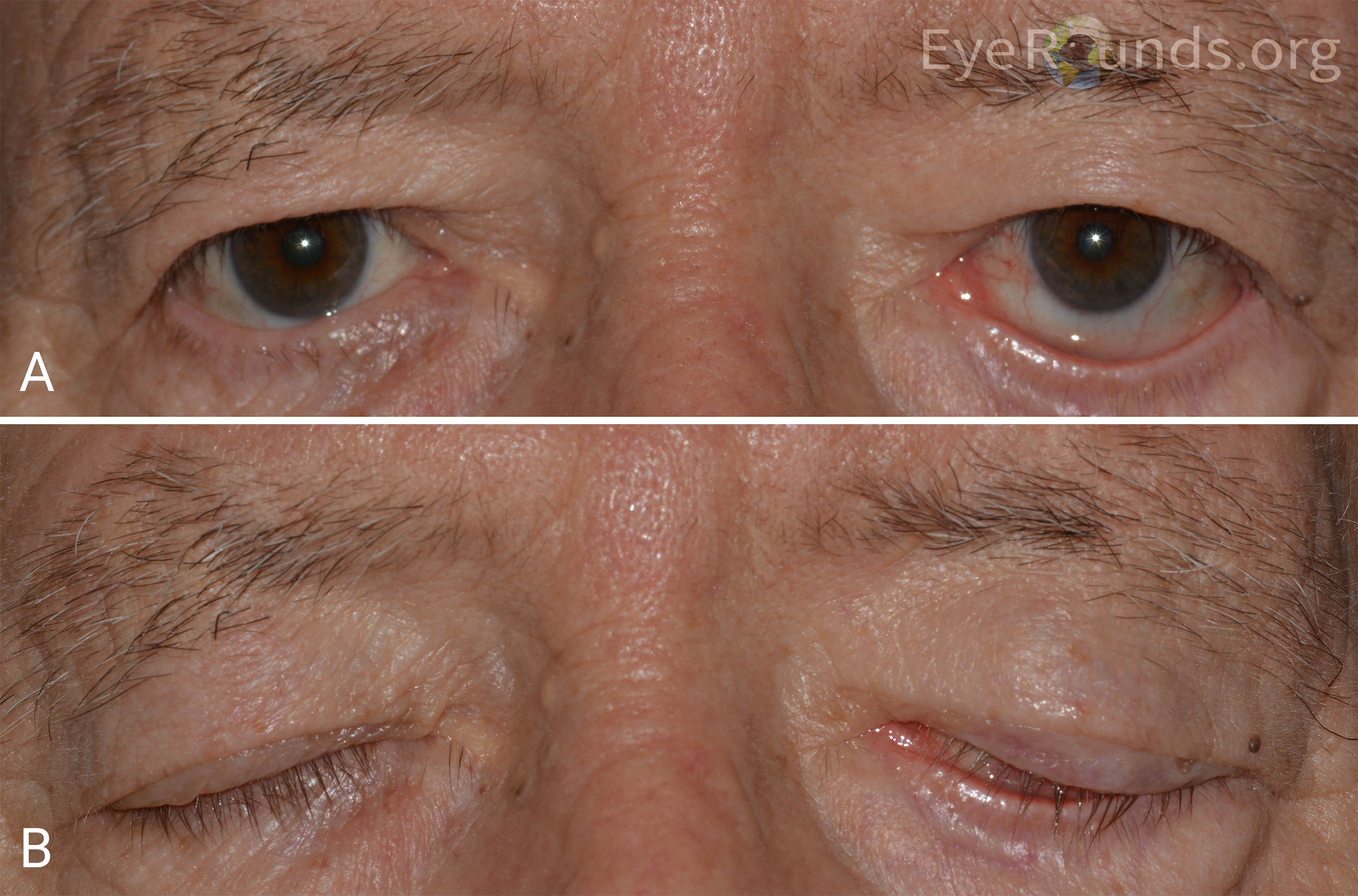 Lower eyelid retraction secondary to facial nerve palsy