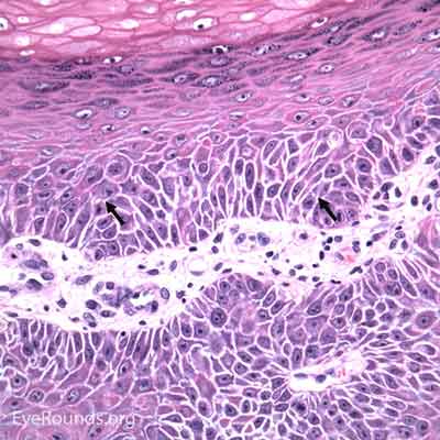 Squamous Cell Carcinoma Histology 