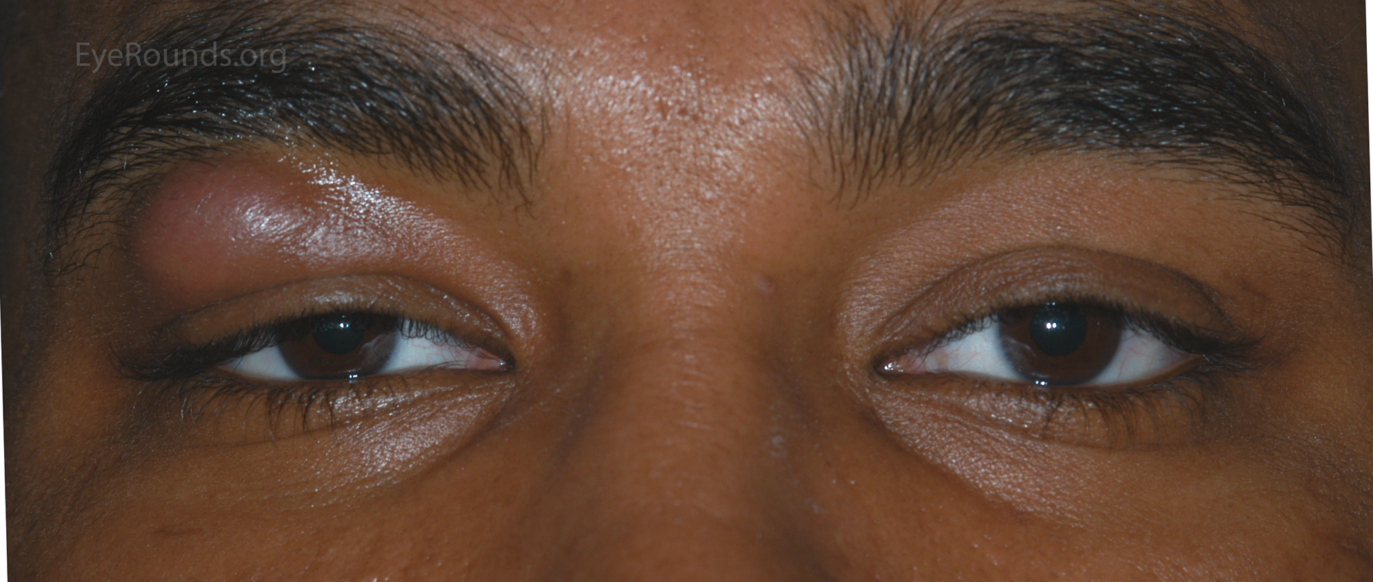 Mechanical ptosis due to granulomatous inflammation