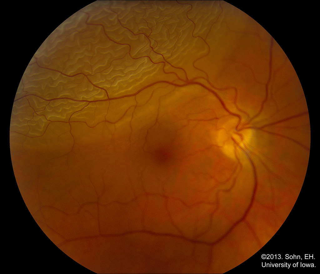 Bullous superotemporal rhegmatogenous retinal detachment 