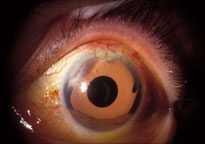 Same eye post-operatively 