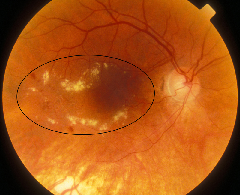 Сетчатки обоих глаз. Гипертоническая ретинопатия Смитом. Солнечная ретинопатия. Псориатическая ретинопатия.