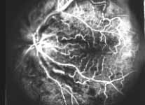 central retinal artery occlusion