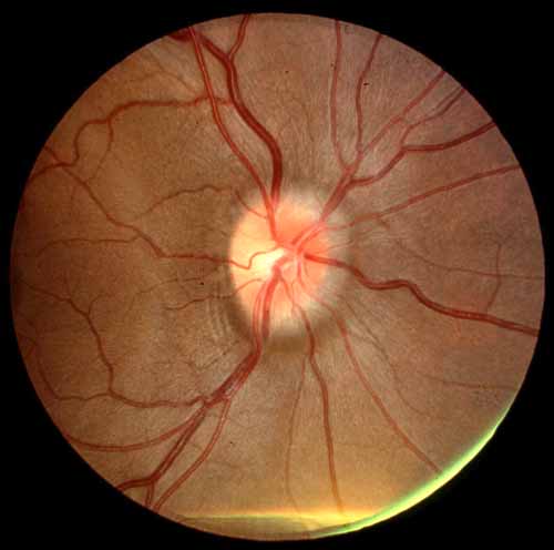 Grade I papilledema, Another example of an optic nerve with mild papilledema.