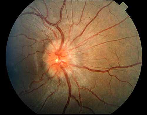 Grade II papilledema. The halo of edema now surrounds the optic disc.