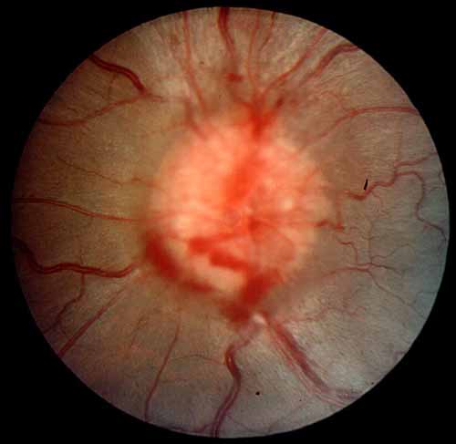 Grade IV papillededema. With more severe swelling in addition to a circumferential halo, the edema covers major blood vessels as they leave the optic disk (grade III) and vessels on the disk (grade IV).
A subretinal hemorrhage is present at 7 o'clock. 