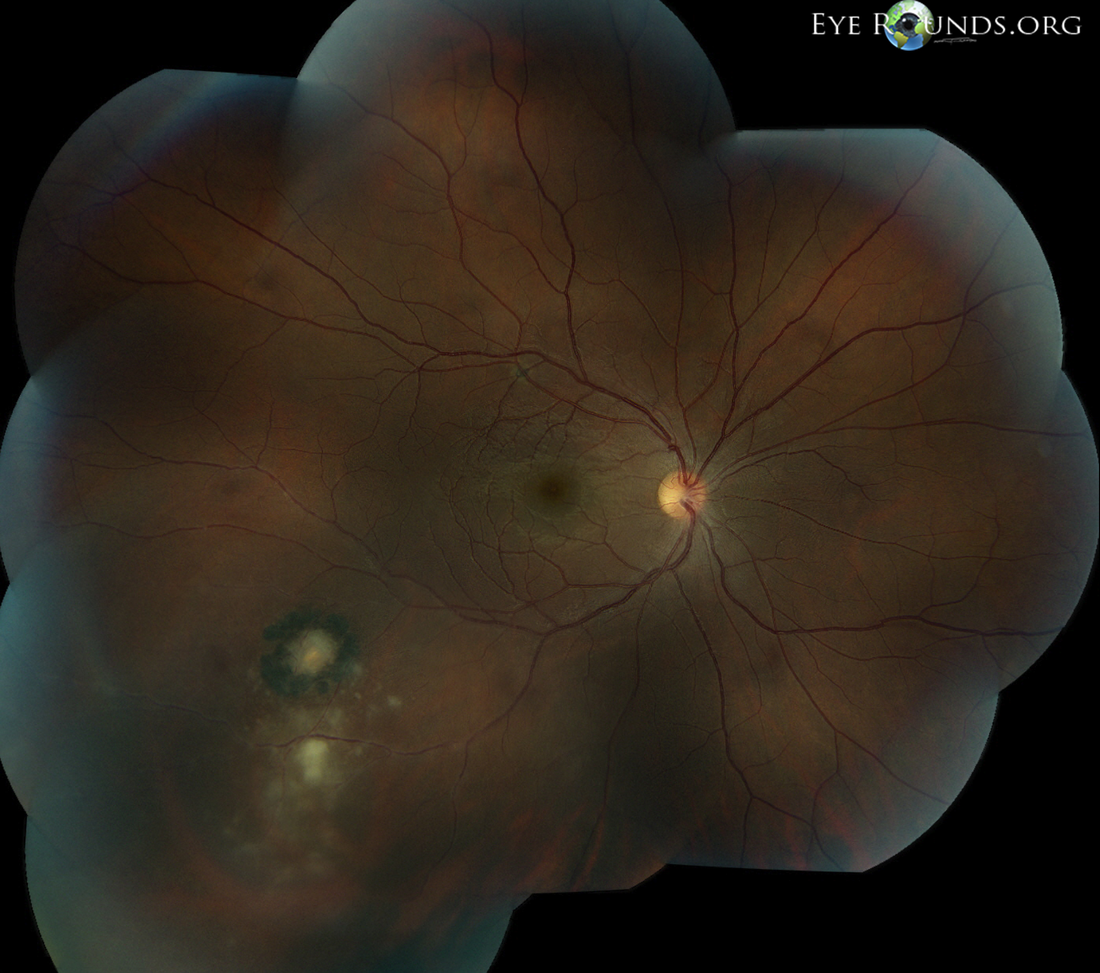 Dilated fundus examination of the right eye showed a well-circumscribed small old peripheral pigmented scar just beyond the inferotemporal arcades