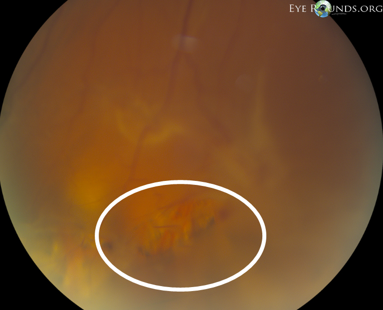 Cirlced  Large retinal break at 6 o’clock with underlying laser scars from prior surgery