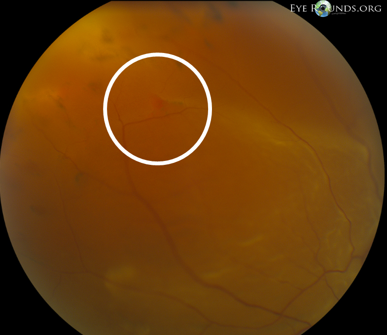 Fundus photo Small retinal break at 1030 o'clock with anterior RPE changes from prior surgery