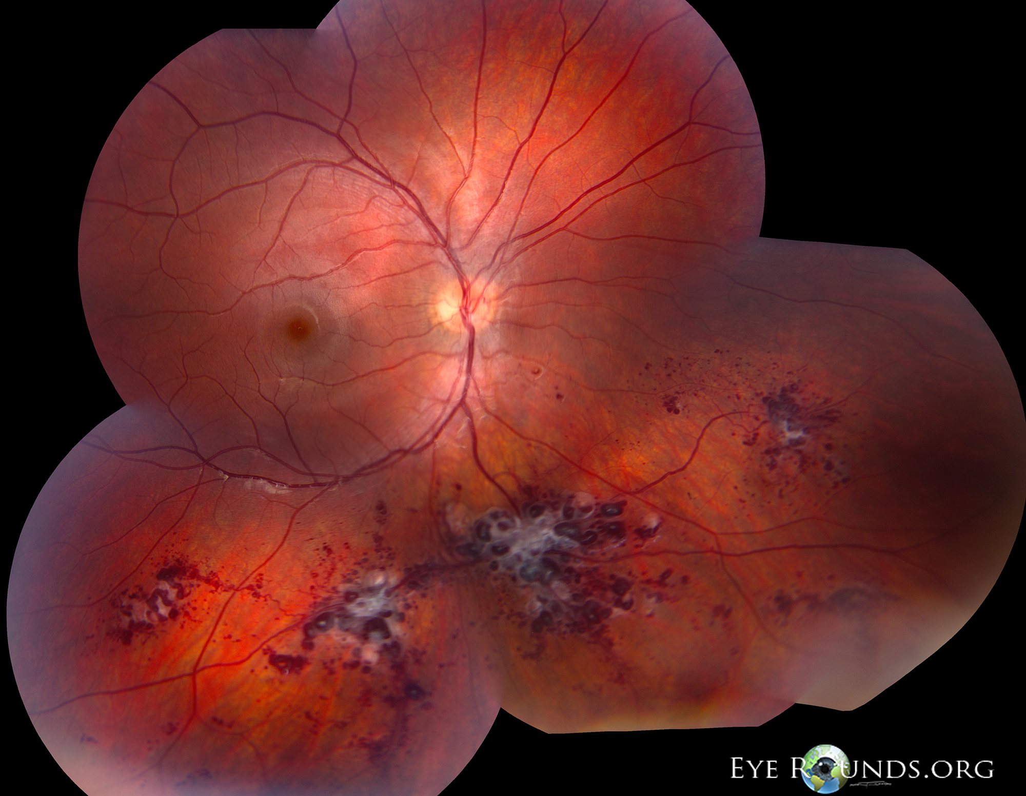 Cavernous Hemangiomas