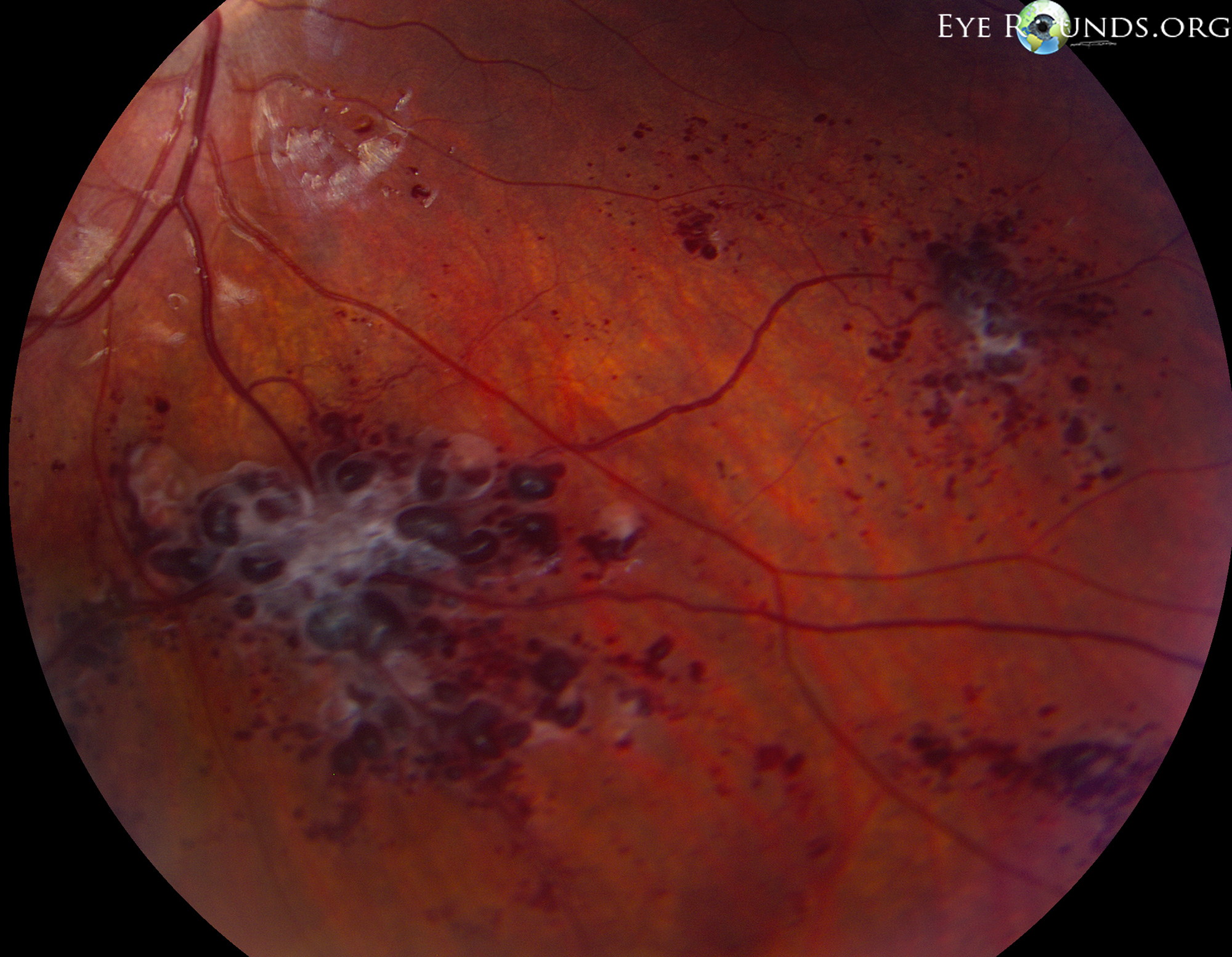 Cavernous Hemangiomas