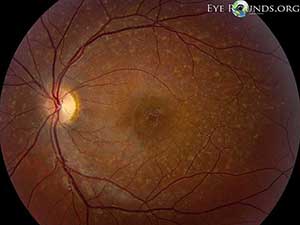 Stargardt Disease, left eye