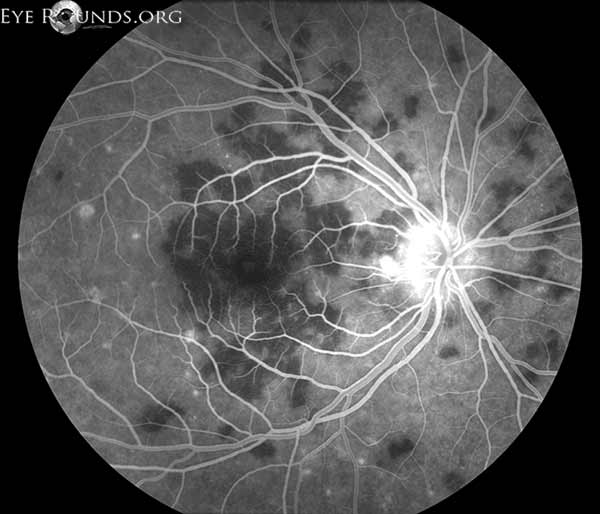 Acute posterior multifocal placoid pigment epitheliopathy (APMPPE)