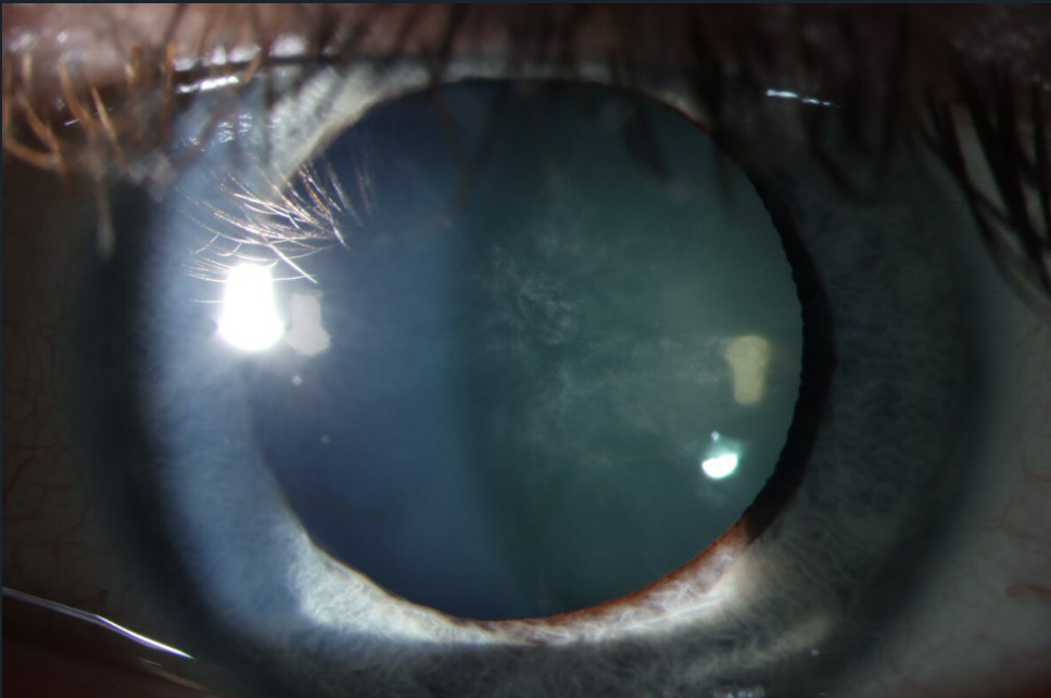 Anterior Subcapsular Catract Slit Lamp