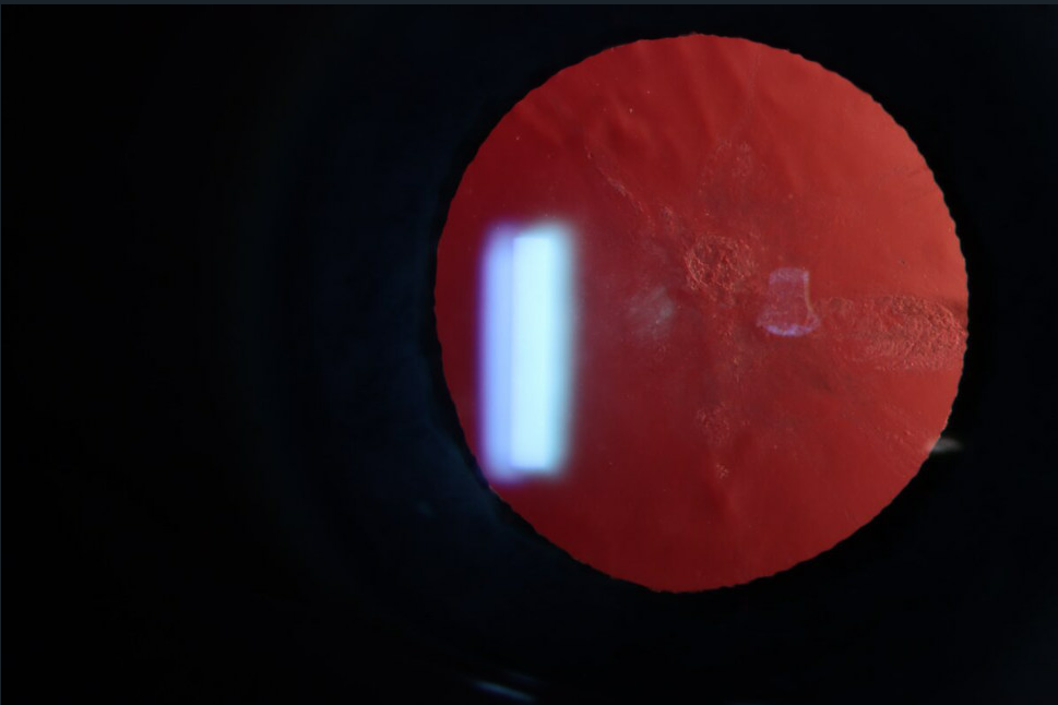 Anterior Subcapsular Catract Slit Lamp