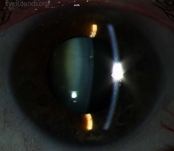 Anterior Subcapsular Cataract