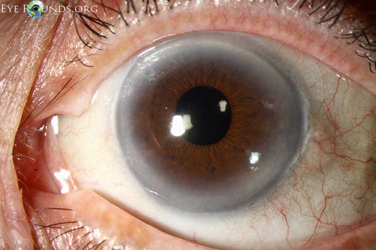 Corneal Arcus Arcus Senilis Online Atlas Of Ophthalmology The