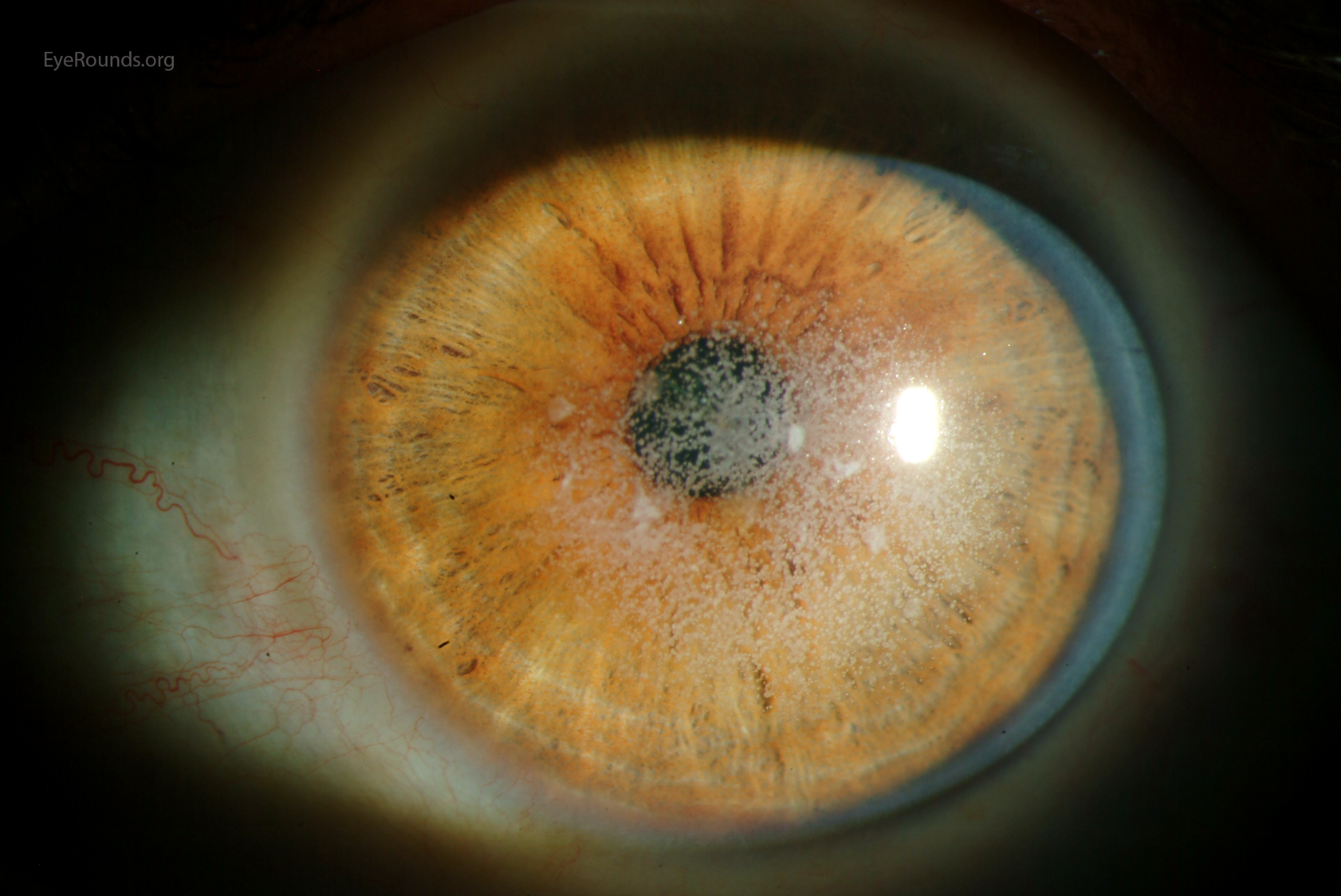 Avellino Type II Granular Corneal Dystrophy EyeRounds Online 