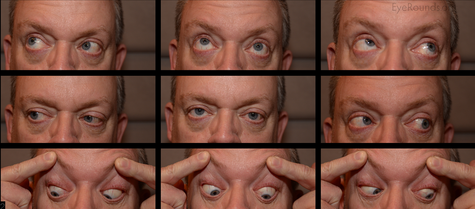 trochlear nerve palsy eye position