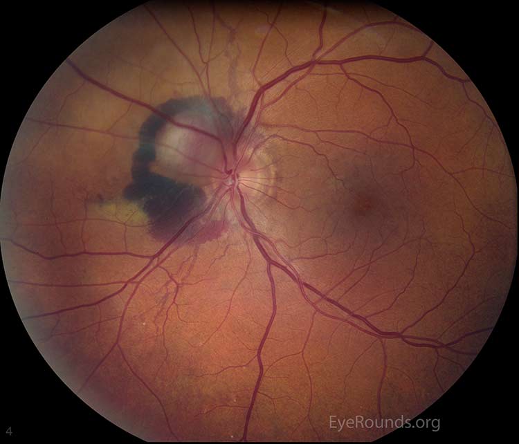 Involuted choroidal neovascular membrane (CNVM) mimicking a granuloma ...