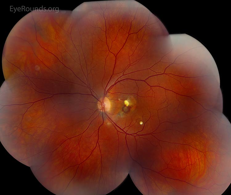 Choroidal Rupture with Development of Choroidal Neovascular Membrane (CNVM)