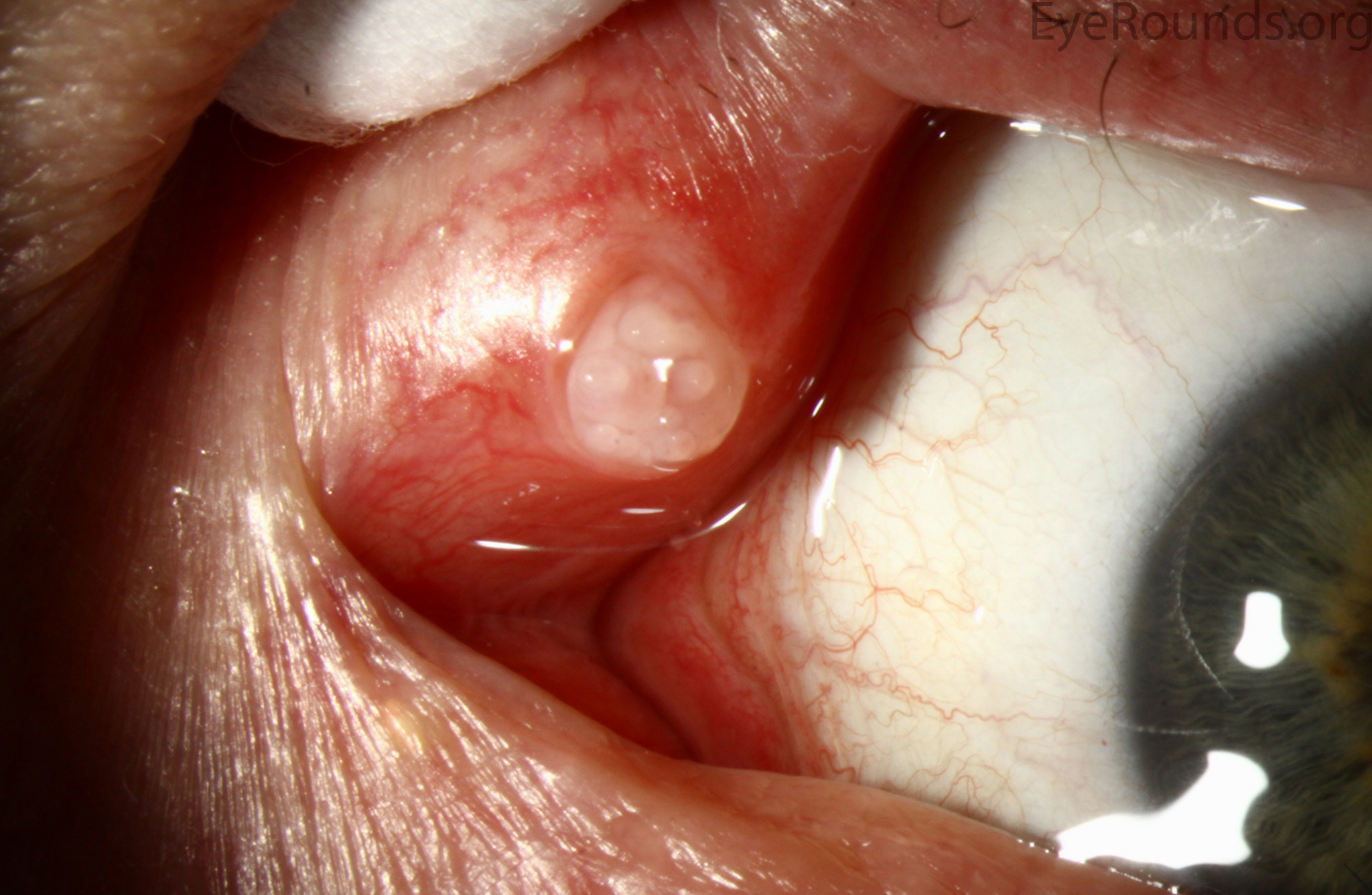 Benign squamous papilloma lesion