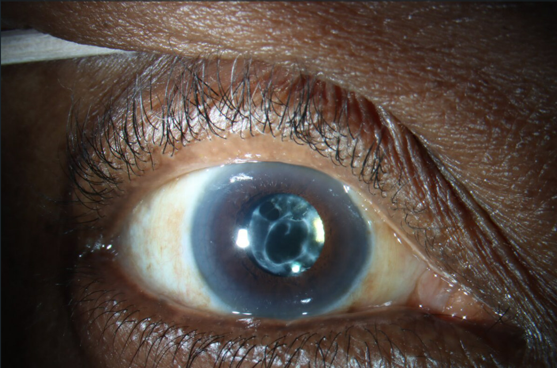 Anterior Capsular Phimosis