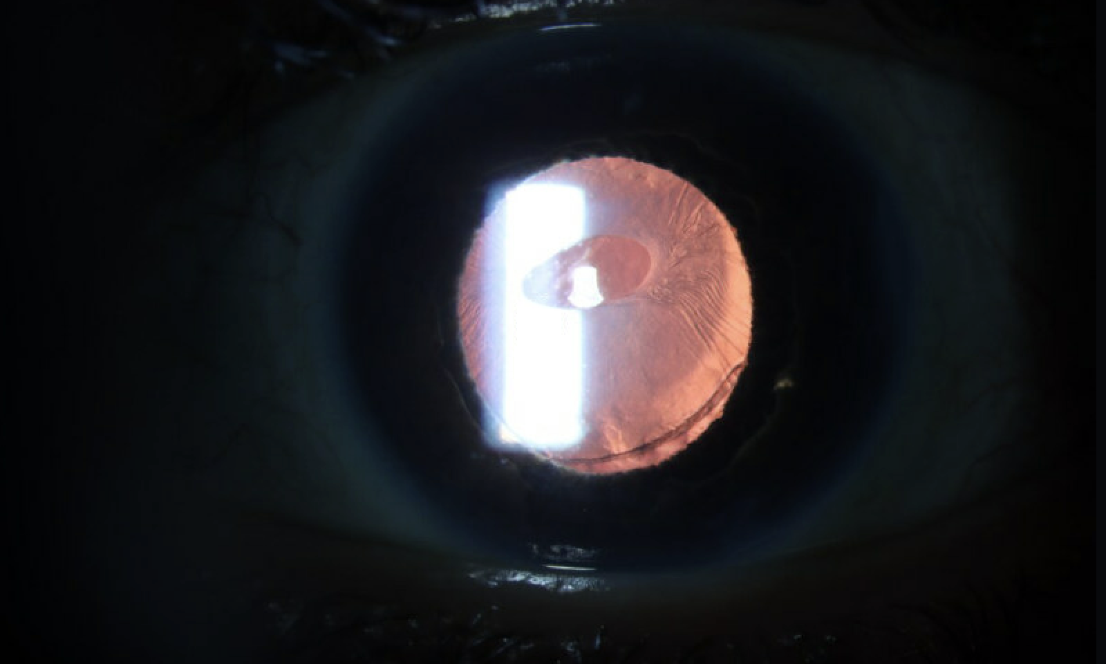 Slit lamp photograph with retro illumination showing mild superior displacement of intraocular lens in anterior capsule contraction syndrome.