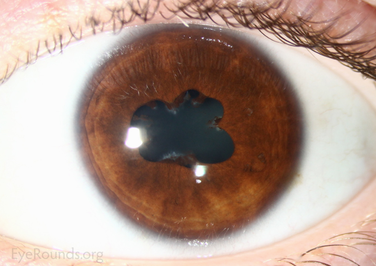 Central posterior synechiae of the eye