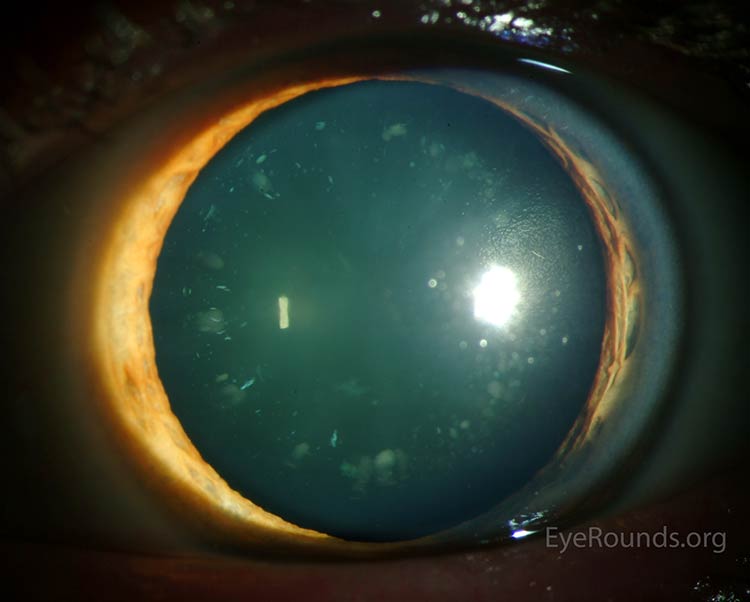 Cerulean Cataract