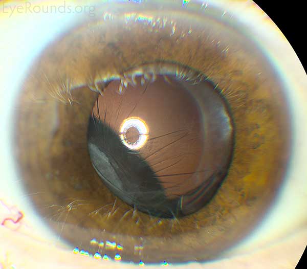 Ciliochoroidal Melanoma