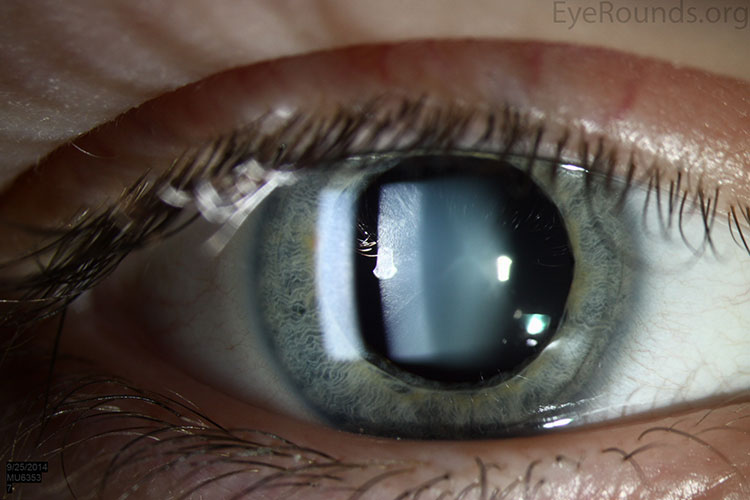 how to take a clear photo of eye