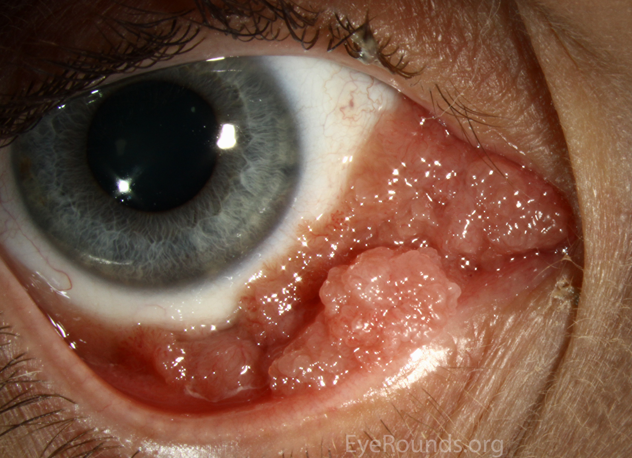 Conjunctival papillomas located in the inferior fornixt