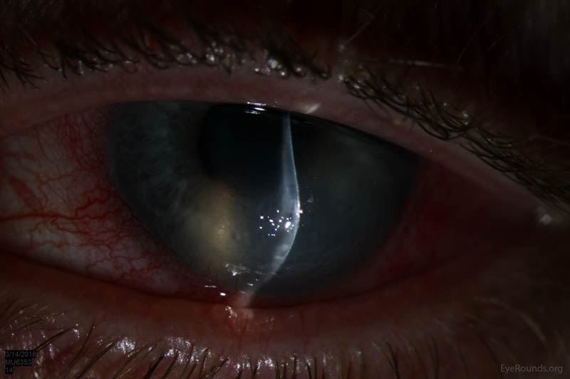 Corneal Hydrops