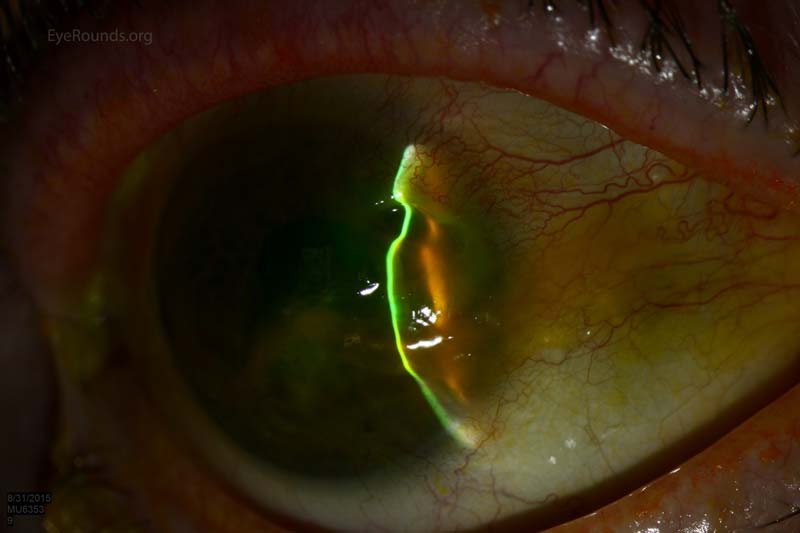 Cyanoacrylate adhesive for corneal perforation secondary to peripheral