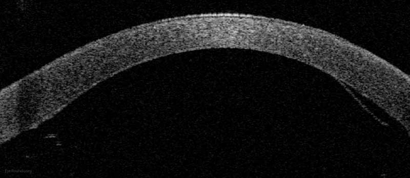 Anterior segment optical coherence tomography demonstrating a limited, peripheral graft edge lift one week after DMEK surgery (right side of image).  The attached portion of the graft mimics normal anatomy due to the precise 1-to-1 replacement of tissue with DMEK.
