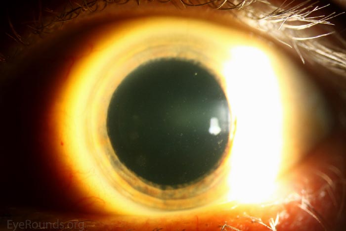 Fleck Corneal Dystrophy (a.k.a. Francois-Neetens speckled corneal dystrophy