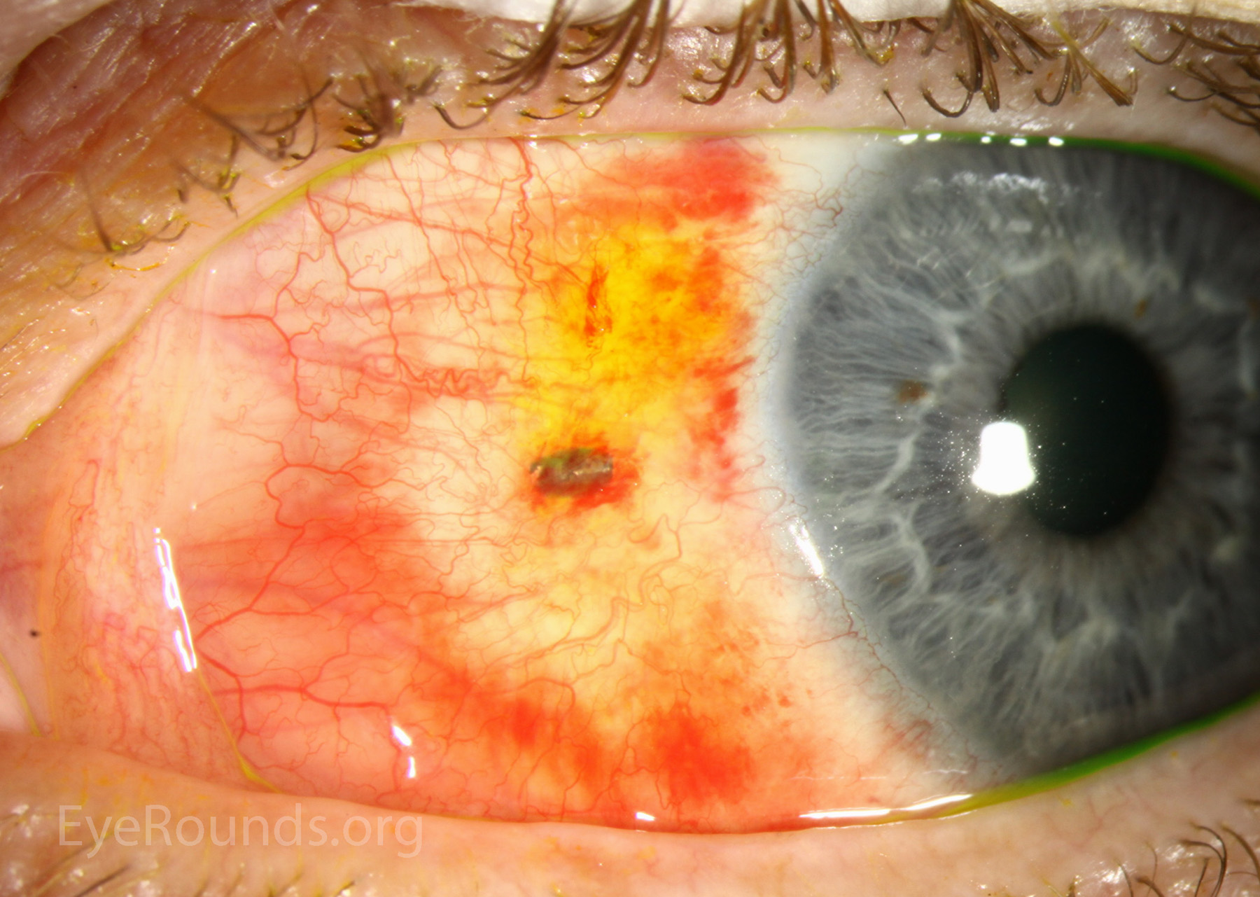 eye with metal foreign body