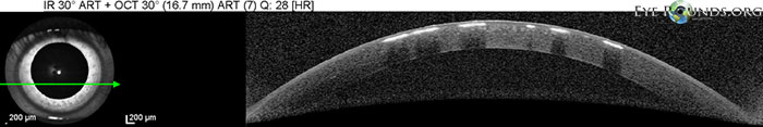 Granular corneal dystrophy