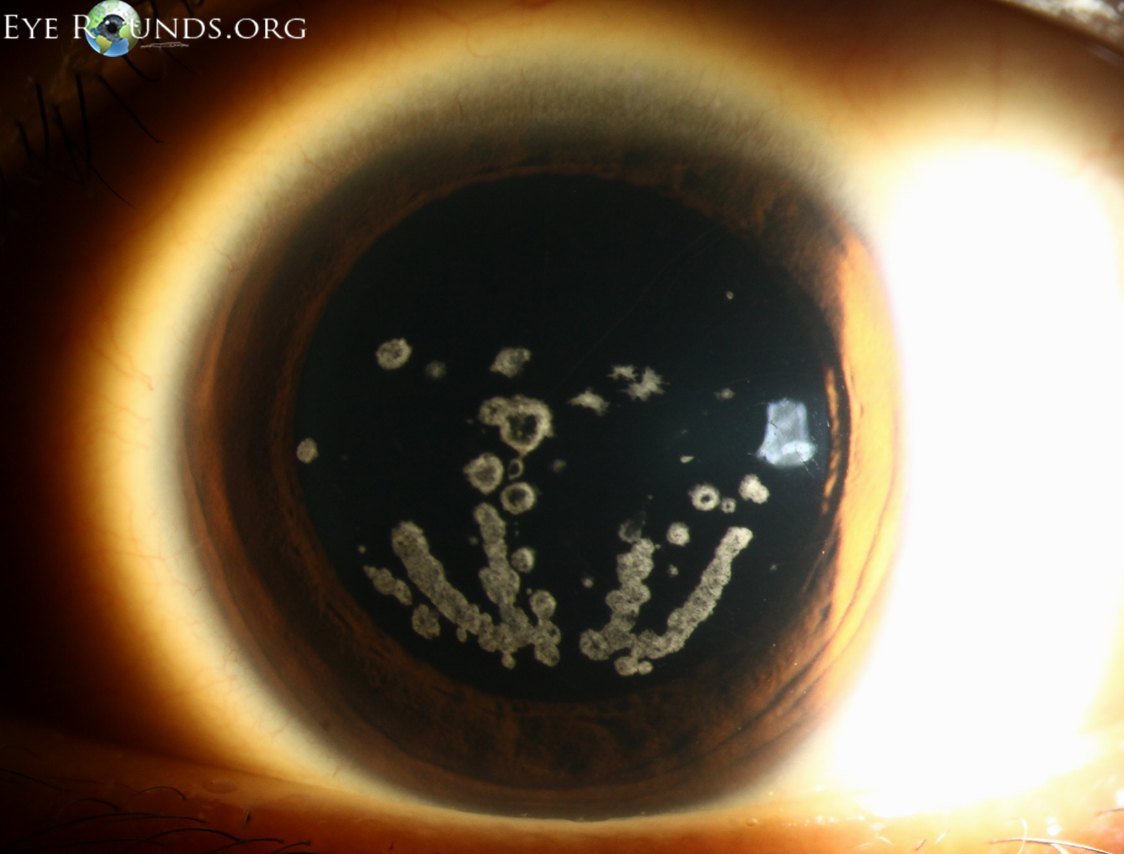 Granular Corneal Dystrophy