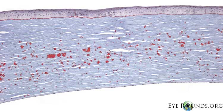 Hyaline deposits stain bright red with Masson trichrome stain