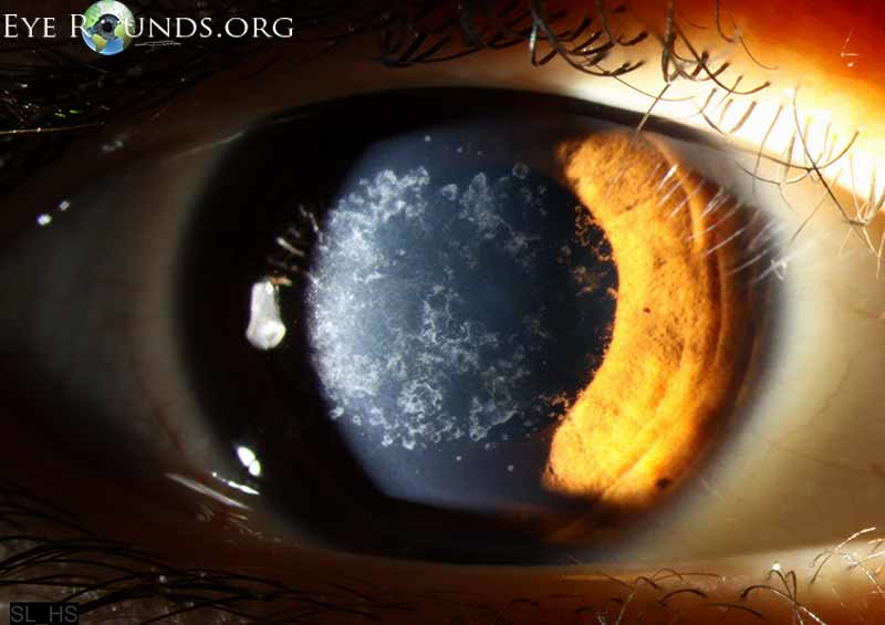 Granular corneal dystrophy type 1: The University of Iowa, Ophthalmology