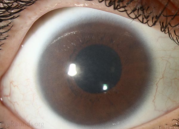 corneal-clouding-in-hurler-s-syndrome