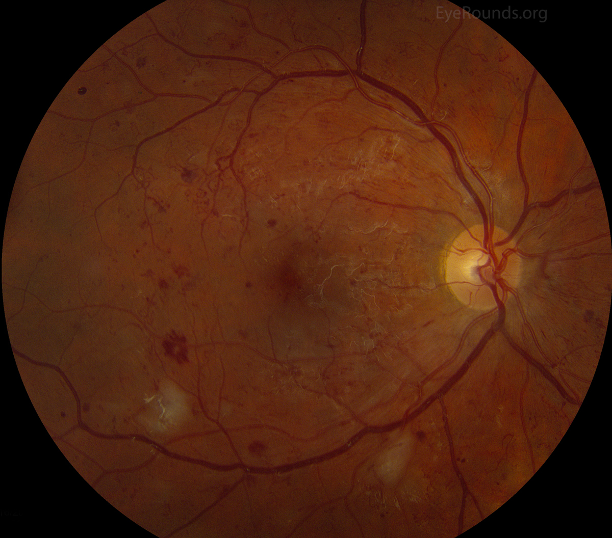 diabetic patient with severe non-proliferative diabetic retinopathy
